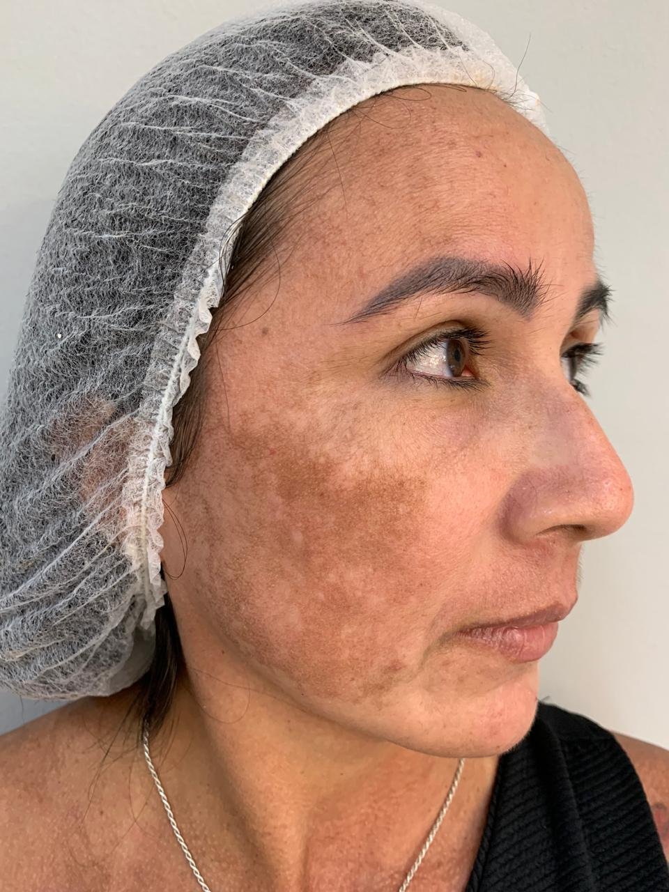 Pele antes do tratamento de melasma