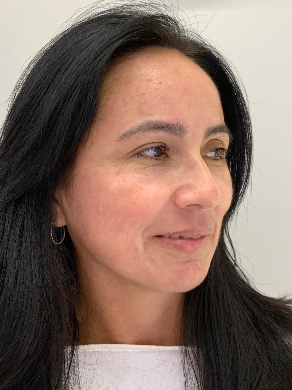 Pele após o tratamento de melasma